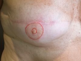 Vorher - Brustwarzenpigmentierung 